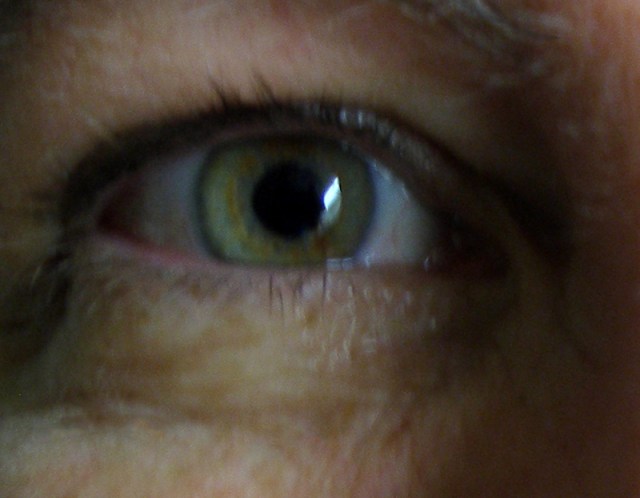 This picture was taken after I had cataract surgery, but it was not the eye that was operated on.