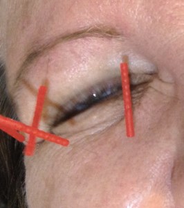 I am so photogenic. I smile for pictures even with needles in me!