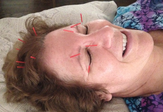 Those needles do prick and sting a little. I thought I’d give acupuncture a try but I’m not sure I’m going to “stick with it.”