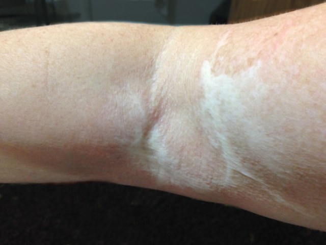 I share this photo of a large scar on my right arm from 4 years ago when I was burned carrying breakfast on a tray to my former husband. (The hot tea spilled.) My scar is sometimes a painful reminder of my former life, but it also is a beautiful example of healing for me.